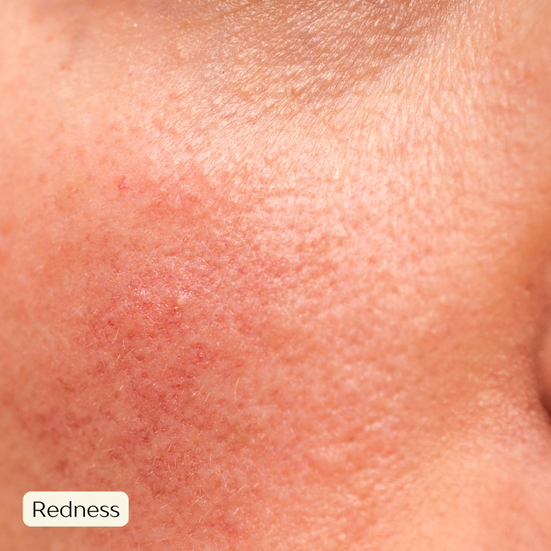 Red sensitive skin
