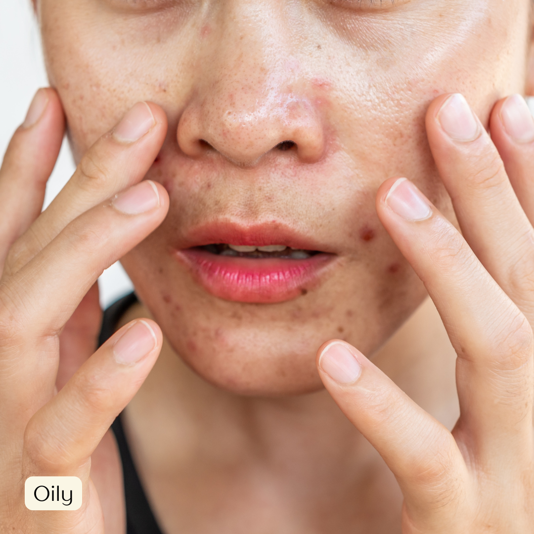 Oily skin