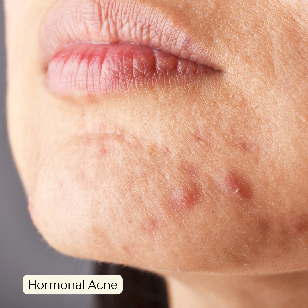 Hormonal acne